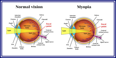 Refractive errors eyeball. Myopia. - obrazy, fototapety, plakaty