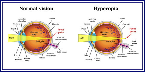 Refractive errors eyeball. Hyperopia.