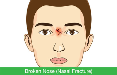 Broken nose on facial of man. Illustration about medical.
