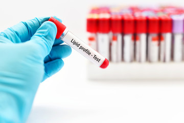 Obraz premium Lipid profile test