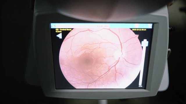 Eye test computer image of retina, showing optic disc cupping