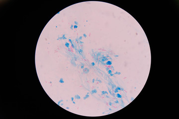 Mycobacterium tuberculosis