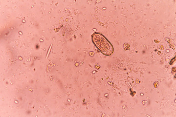 The egg of capillaria philinensis in stool exam