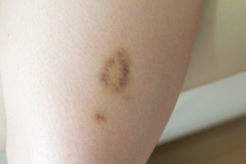 Closeup Bruise on wound woman leg skin