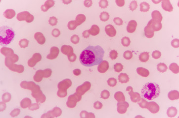 plasma cell human blood cell under microscope,complete blood count.