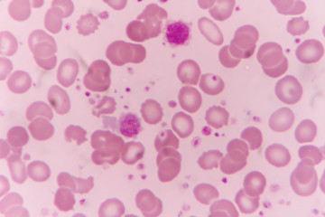 in Slide blood smear show giant platelet under microscope