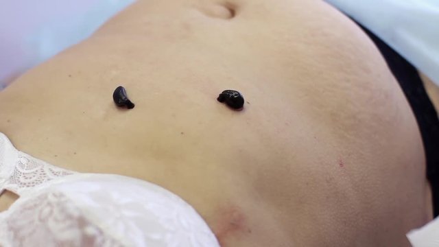 Hirudotherapy. The procedure hirudotherapy, treatment with leeches