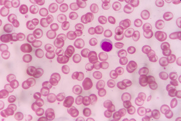 in Slide blood smear show target cell for complete blood count in microscope