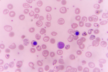in slide blood smear show Nucleated red cell for complete blood count