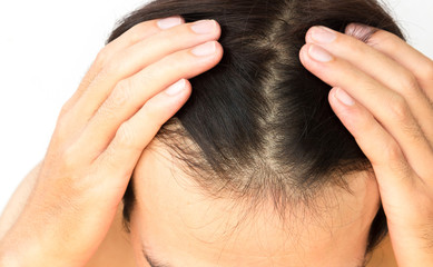 Fototapeta premium Young man serious hair loss problem for hair loss concept