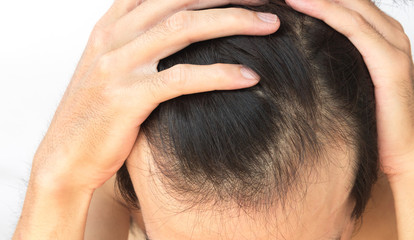 Fototapeta premium Young man serious hair loss problem for hair loss concept