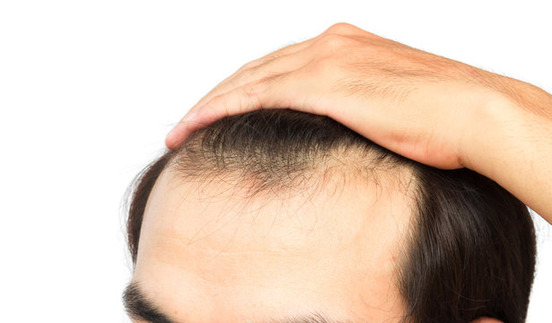 Hair Loss Men Images – Browse 44,235 Stock Photos, Vectors, and Video |  Adobe Stock