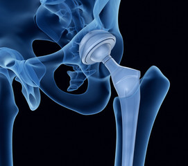 Hip replacement implant installed in the pelvis bone. X-ray view. Medically accurate 3D illustration - obrazy, fototapety, plakaty
