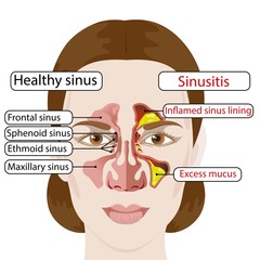 Sinusitis. Healthy and inflamed sinuses. Medical poster