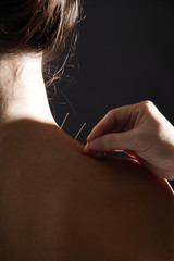 therapist applying acupuncture needles to woman's neck - obrazy, fototapety, plakaty