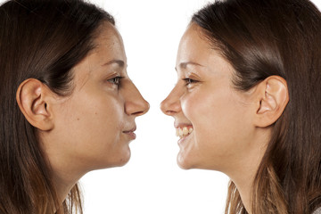 comparative portrait of the same woman, before and after rhinoplasty