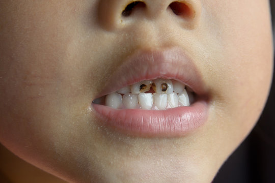 Child tooth decay. smiling children.