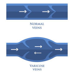 Vector illustration of a varicose vein and normal vein. Flat style.