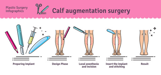 Vector Illustrated set with calf augmentation surgery © ant_art19