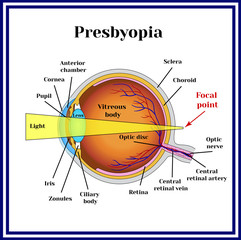 Refractive errors eyeball. Presbyopia. The lens loses its flexibility whith age.