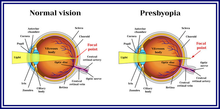 Refractive errors eyeball. Presbyopia. The lens loses its flexibility whith age.