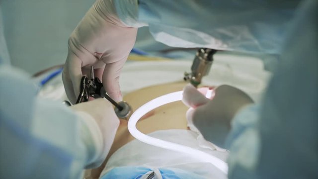 Surgeons team preforming operation in hospital operating theater, Surgeon operating patient,wearing surgical gown,operating room, holding hands,working with surgical instruments. Laparoscopy, close-up