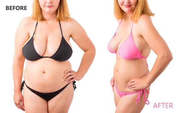 Woman in bikini posing before and after weight loss