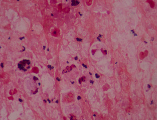 Gram stain showing blue cells gram positive in single,in pair,in