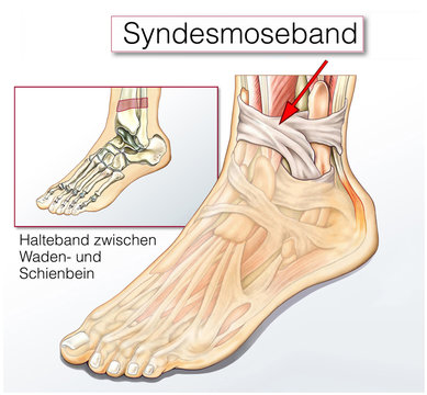 Syndesmoseband.Halteband