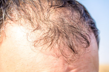 balding head