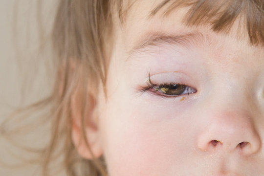 Kleines Kind mit Bindehautentzündung am rechten Auge