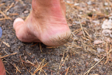 Close up photo pair of cracked heels. Male back view.