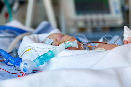 Child with respirator in intensive care unit after heart surgery. Shallow depth of field. 