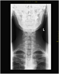 X-ray of the neck - inversion of cervical lordosis, reduced disc height, degeneration, arthrosis.