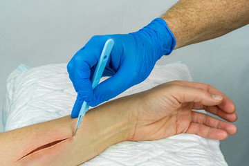 Hand with blue medical glove holding a scalpel making an incision on an arm. Open wound surgery....