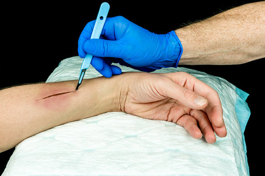 Hand with blue medical glove holding a scalpel making an incision on an arm. Open wound surgery. Close up with black background.