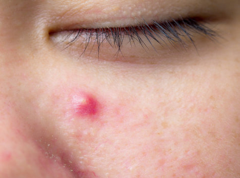 The infected pustulous acne on face, selective focus on acne