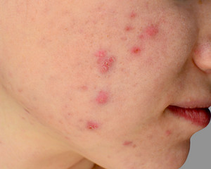 Human skin Acne