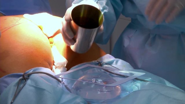implants to increase the buttocks