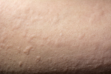 Naklejka premium urticaria or allergy rash
