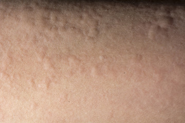 Fototapeta premium urticaria or allergy rash