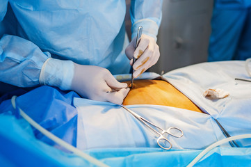 Operation using endoscopy in gynecology