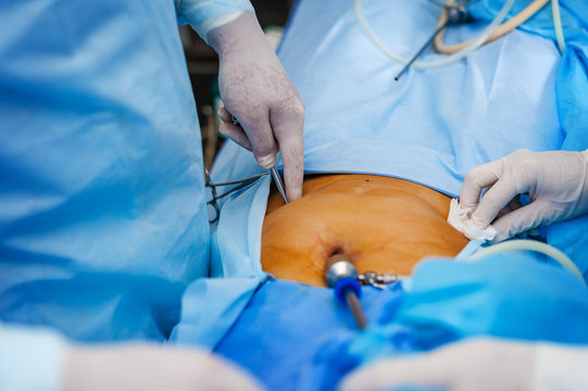 Operation using endoscopy in gynecology