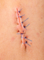 Seven non absorbable sutures in a person's upper back. 