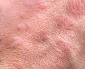 Fototapeta premium Allergy damaged human skin