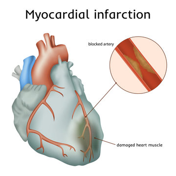 Myocardial infarction. Heart attack. Blocked artery, damaged heart muscle. Anatomy illustration. Colorful image, white background.