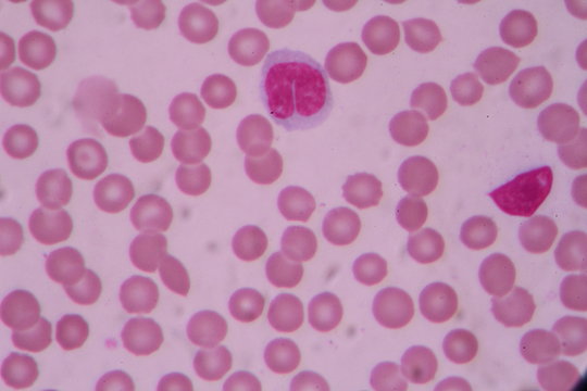 Blood smear shows large number of cancer leukemia cells(Blast cells)