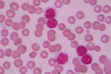 Blood smear shows large number of cancer leukemia cells(Blast cells)