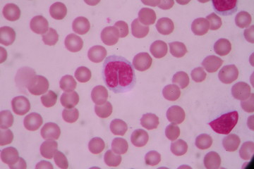 Blood smear shows large number of cancer leukemia cells(Blast cells)