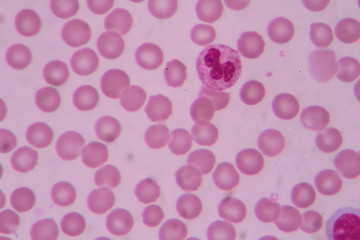 Blood smear shows large number of cancer leukemia cells(Blast cells)